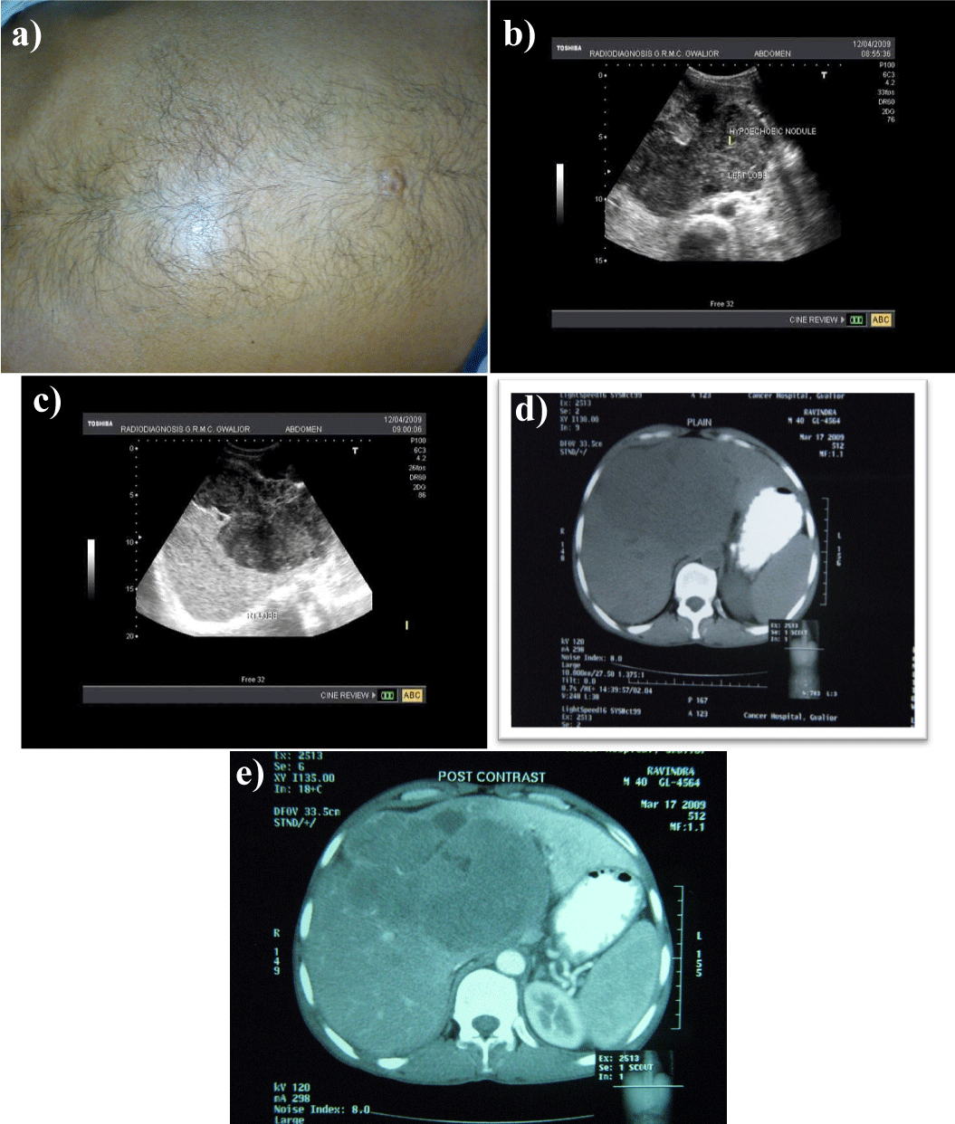 Hepatic Lymphoma Ct