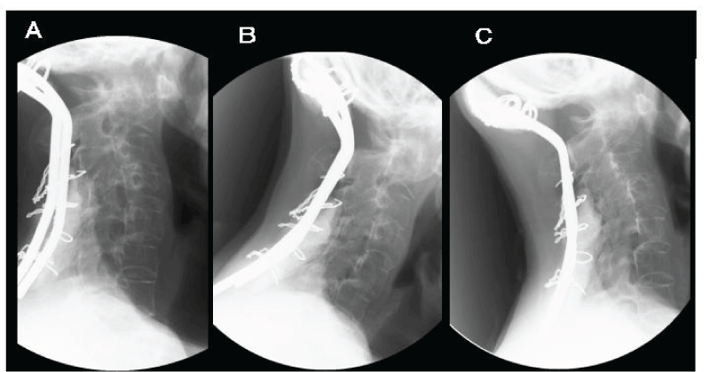 Note no recognizable flexion