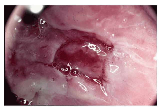 Oral Pemphigus