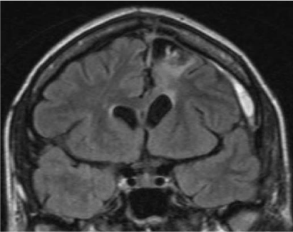 Frontal Mri