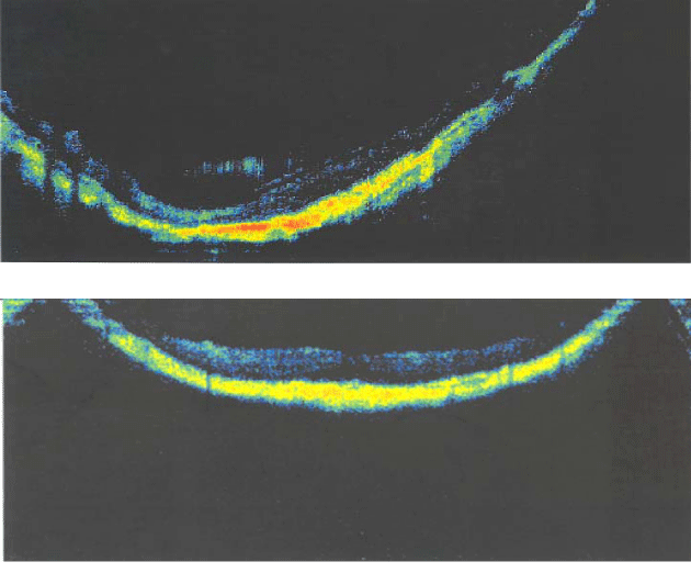 Myopic Maculopathy