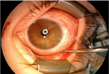 End Stage Glaucoma