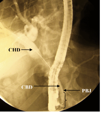 common bile duct stone. CBD common bile duct,