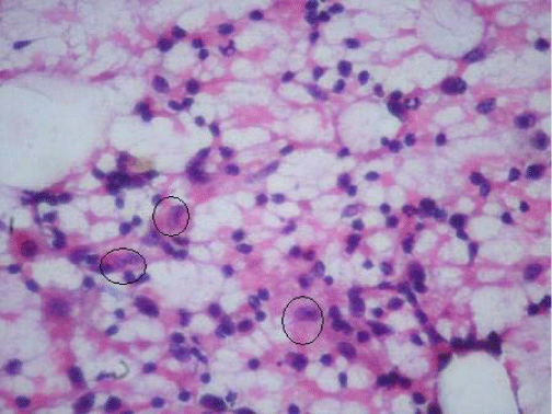 epithelioid histiocytes