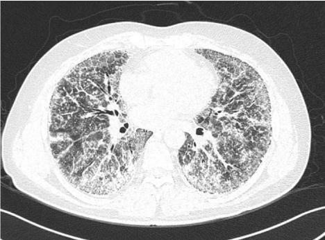 Alveolar Microlithiasis