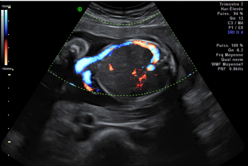 Persistent Right-sided Umbilical Vein And Azygos Continuity Associated 