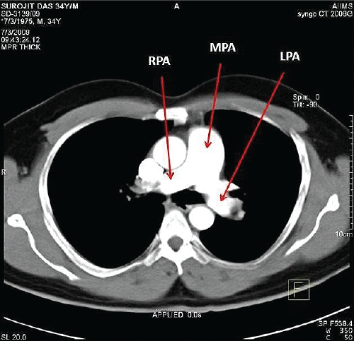 Massive Pulmonary Embolism