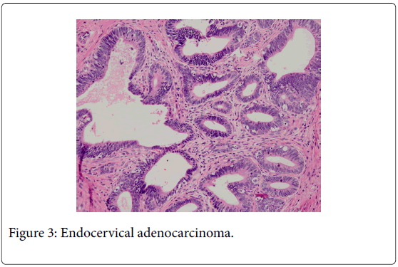 Endocervical Polyp Histology