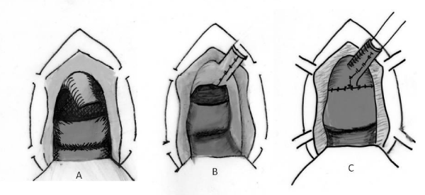 Surgical Approach To Obstetric Fistula Repair In Niamey, Niger: A ...