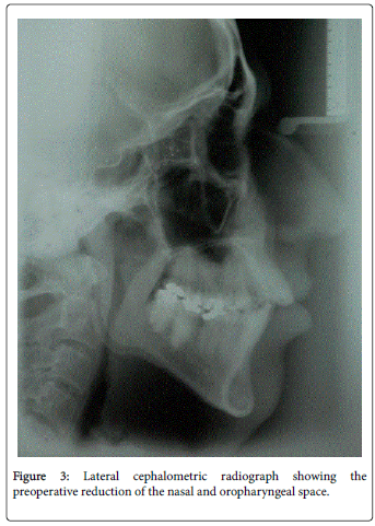 otolaryngology-Lateral-cephalometric-radiograph-oropharyngeal