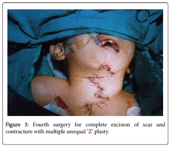 otolaryngology-born-Fourth-surgery-excision-scar-contracture