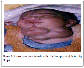 otolaryngology-born-female-chief-deformity-lips