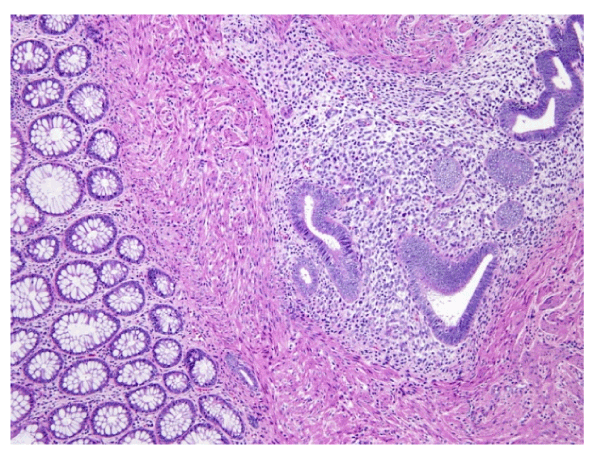 Colonic Endometriosis Mimicking Sigmoid Cancer: A Case Report | Open ...