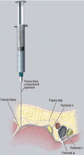 A Randomized and Observer Blinded Comparison of Continuous Femoral ...