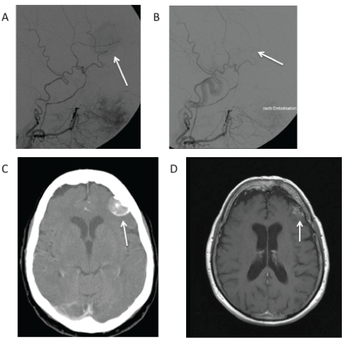 Perspectives In Meningioma Treatment Omics International - 