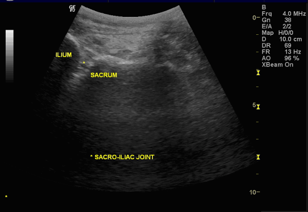 Si Joint Ultrasound