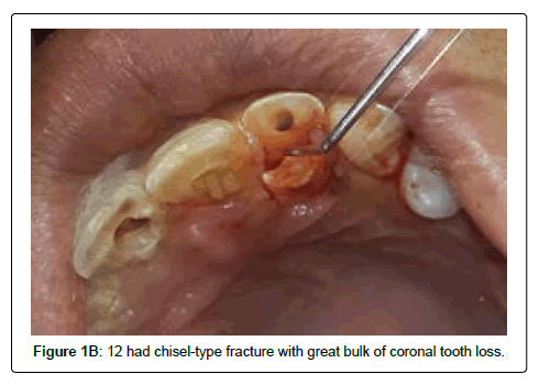 oral-hygiene-and-health-coronal