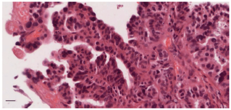 Micropapillary