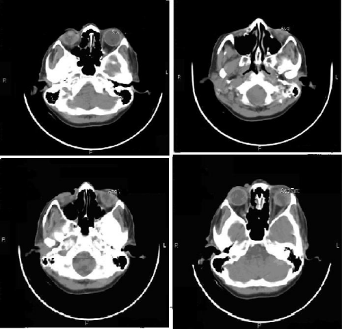 Ct Scan Of The Patient 7196