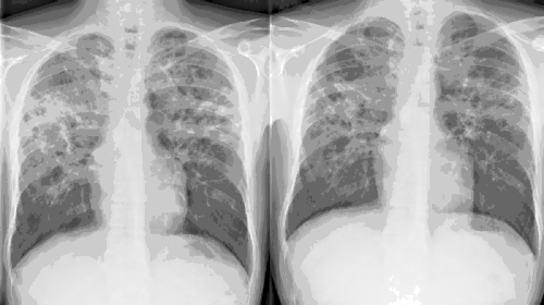 Chest skiagram of the patient