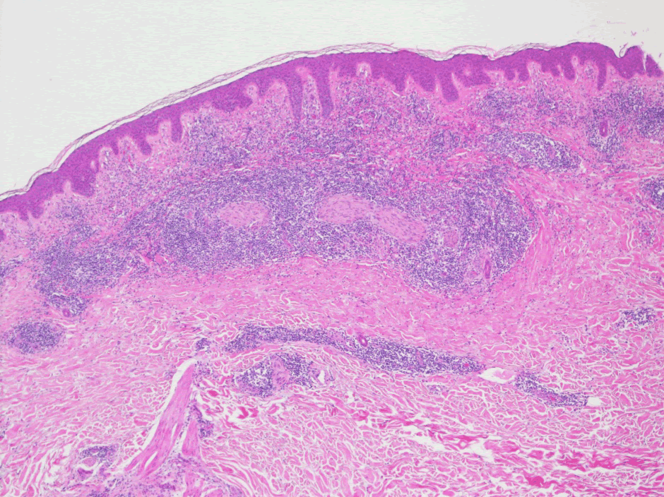 skin biopsy shows a superficial