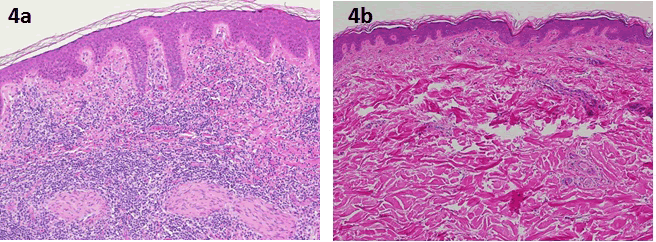 Figure 4a Lesional skin