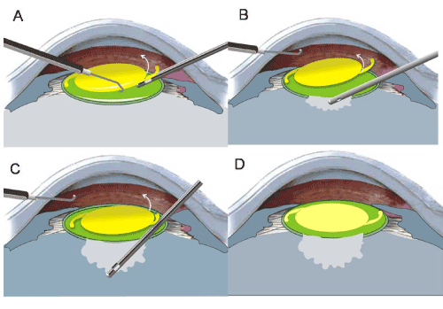 LARV: Limbal Approach Retropseudophakic Vitrectorrhexis and Vitrectomy ...