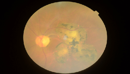 macular