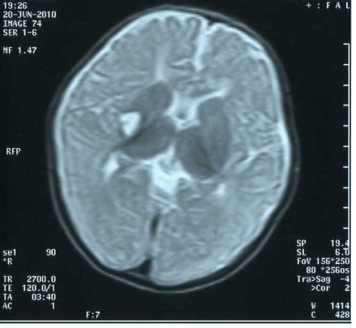 Basal Ganglia Infarct in an Infant with Sickle Cell Disease - A Rare ...