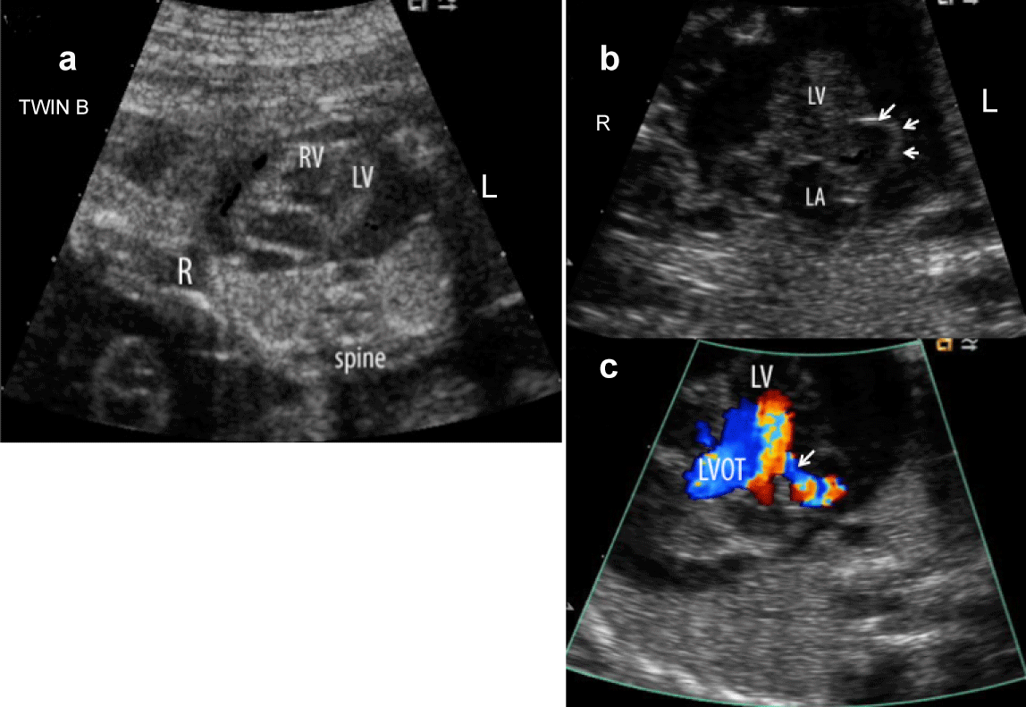 images for fetal echo cardiograph views