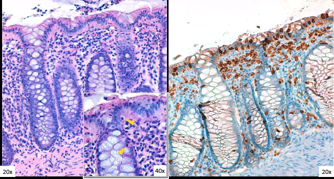 biopsy