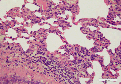 few collapsed alveoli, with inflammatory