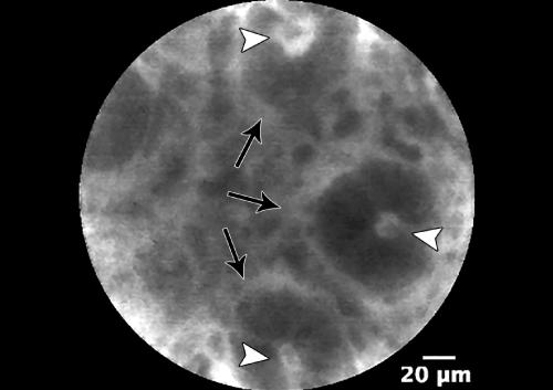 ischemic