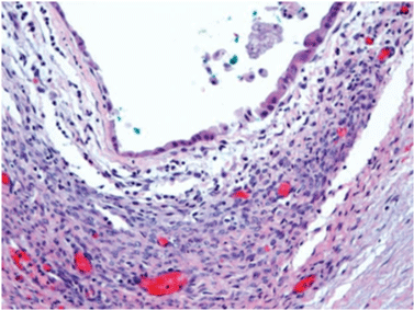 cystadenoma