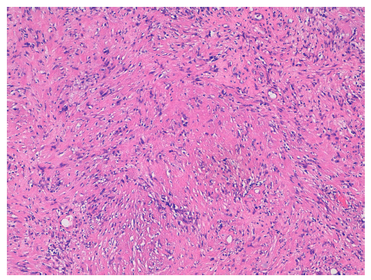 Schwannoma