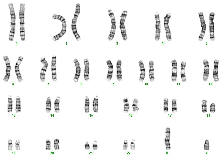 9 хромосома. Кариотип XY. Кариотип 3p 12. Кариотип 46 XY пол. Кариотип 46 XY У плода.