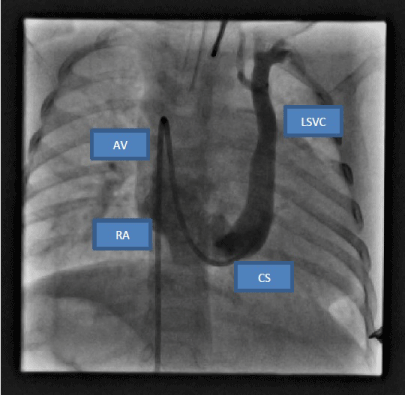 Rare Case of Bilateral Superior Vena Cava, Persistent Left Superior ...