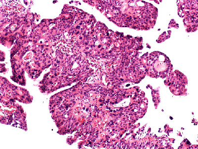 papillocarcinoma