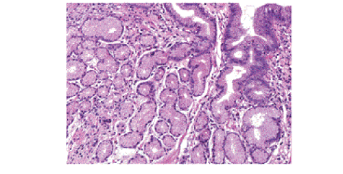 The Status Of Histopathology In The Diagnosis Of Gastroesophageal Reflux Disease Time For