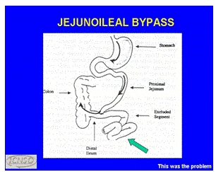 Jejunoileal