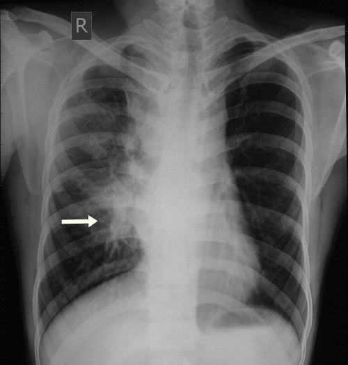 Mediastinal Zygomycosis (Mucormycosis): an Unusual Manifestation of ...