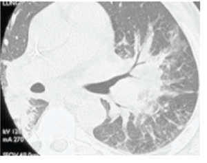 nodular