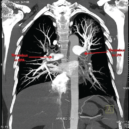 massive pulmonary embolism