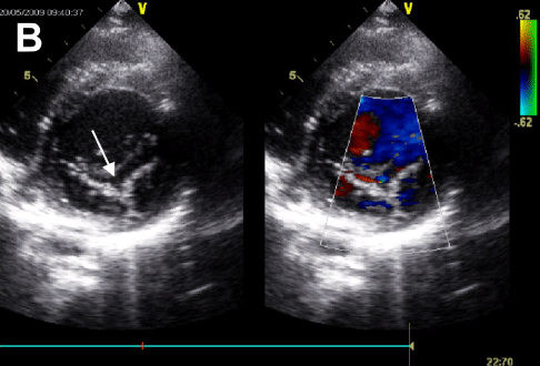 Isolated Cleft of the Posterior Mitral Valve Leaflet in a Patient with ...