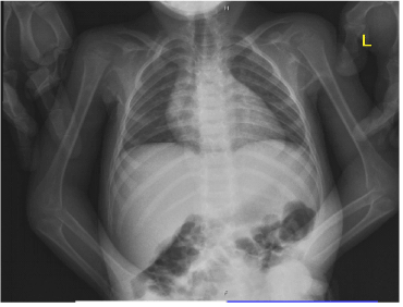 First Reported Case of Fibrodysplasia Ossificans Progressiva in Saudi ...