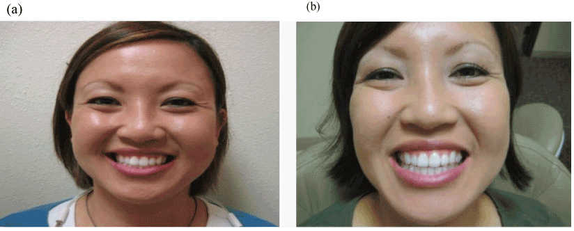 Combined DNA applianceTM and InvisalignTM Therapy without Interproximal ...