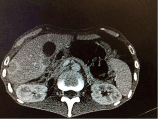 Peritoneal