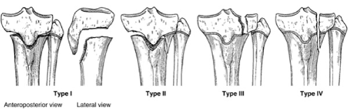 Proximal Tibial Epiphyseal Fracture, Complete Separation: A Rare ...