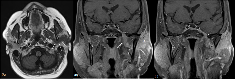 Imaging Of Auriculotemporal Nerve Perineural Spread Omics International 6116