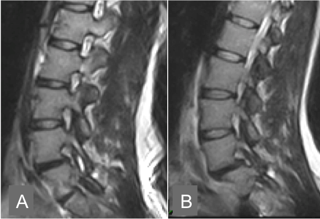 Spinal instability